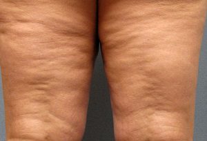 celulitis blanda