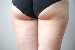 celulitis dura
