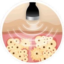 ultrasonido_terapia